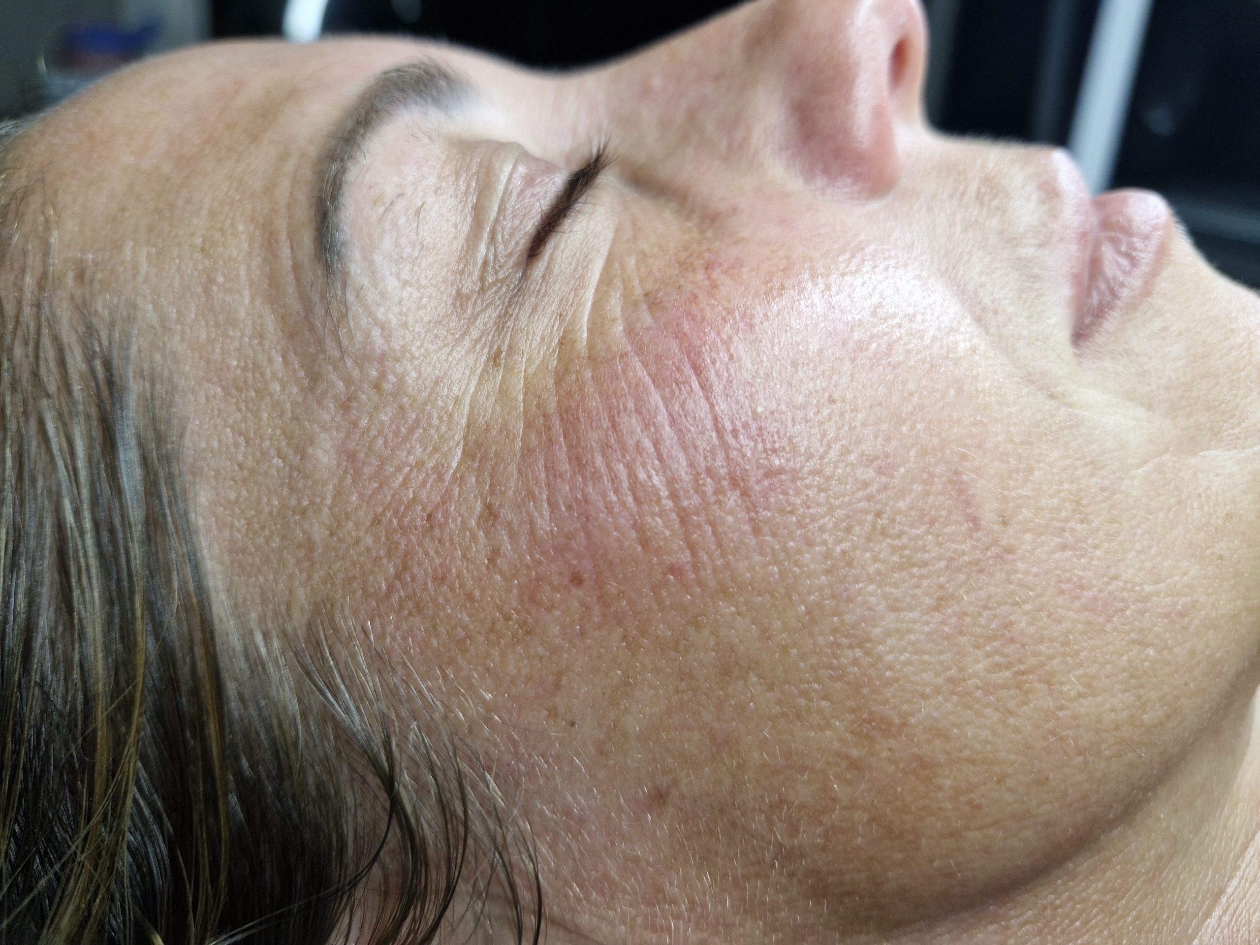 After Plasma Fibroblast Facial