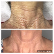 Plasma Fibroblast neck before and after