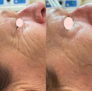 Non Surgical Facelift - Gold Coast Mobile Beauty Bar