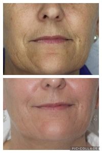 Non Surgical Facelift - Gold Coast Mobile Beauty Bar
