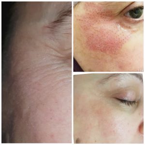 Non Surgical Facelift - Gold Coast Mobile Beauty Bar