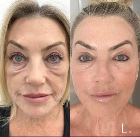 plasma Non-surgical facelift. before and after. Gold Coast Mobile Beauty Bar