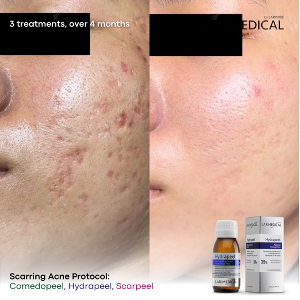 Medical Peels Acne scarring