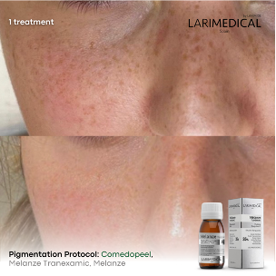 Medical Peels Pigmentation