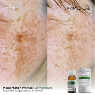 Medical Peels Pigmentation2