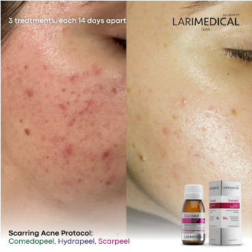 Medical Peels acne scarring 2