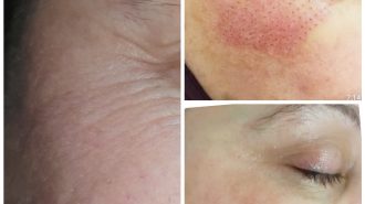 plasma fibroblast before and after2.jpg